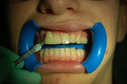 Sbiancamento dentale professionale con perossido di idrogeno