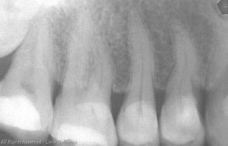 Endodonzia: casi clinici