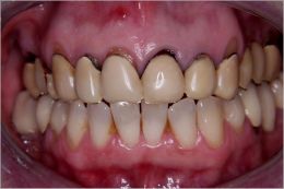 Capsule in ceramica integrale su denti naturali ed impianti
