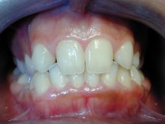 Trattamento ortodontico con metodica invisalign di agenesia dentaria multipla e  impianti