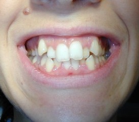 Trattamento ortodontico con metodica Invisalign