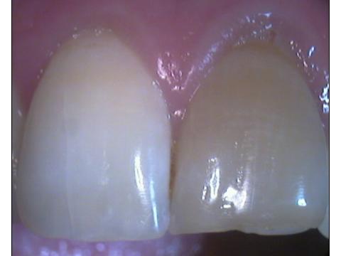 Sbiancamento di denti non vitali (necrotici o già devitalizzati)