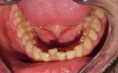 Terapia ortodontica invisibile in 5 mesi