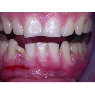 Estrazione elemento dentario e impianto dentale