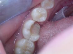 Laser e intarsio: come recuperare un molare fratturato