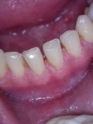 Chiusura conservativa di un diastema inferiore