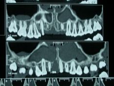 Protesi Metal-free degli incisivi superiori