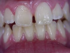 Diastema? No Problem!