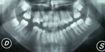 Canino Incluso, connubio tra chirurgia e ortodonzia.