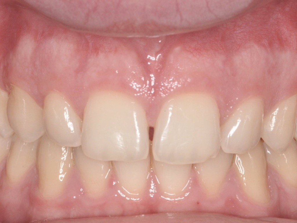 Implantologia dentale post estrattiva in zona estetica