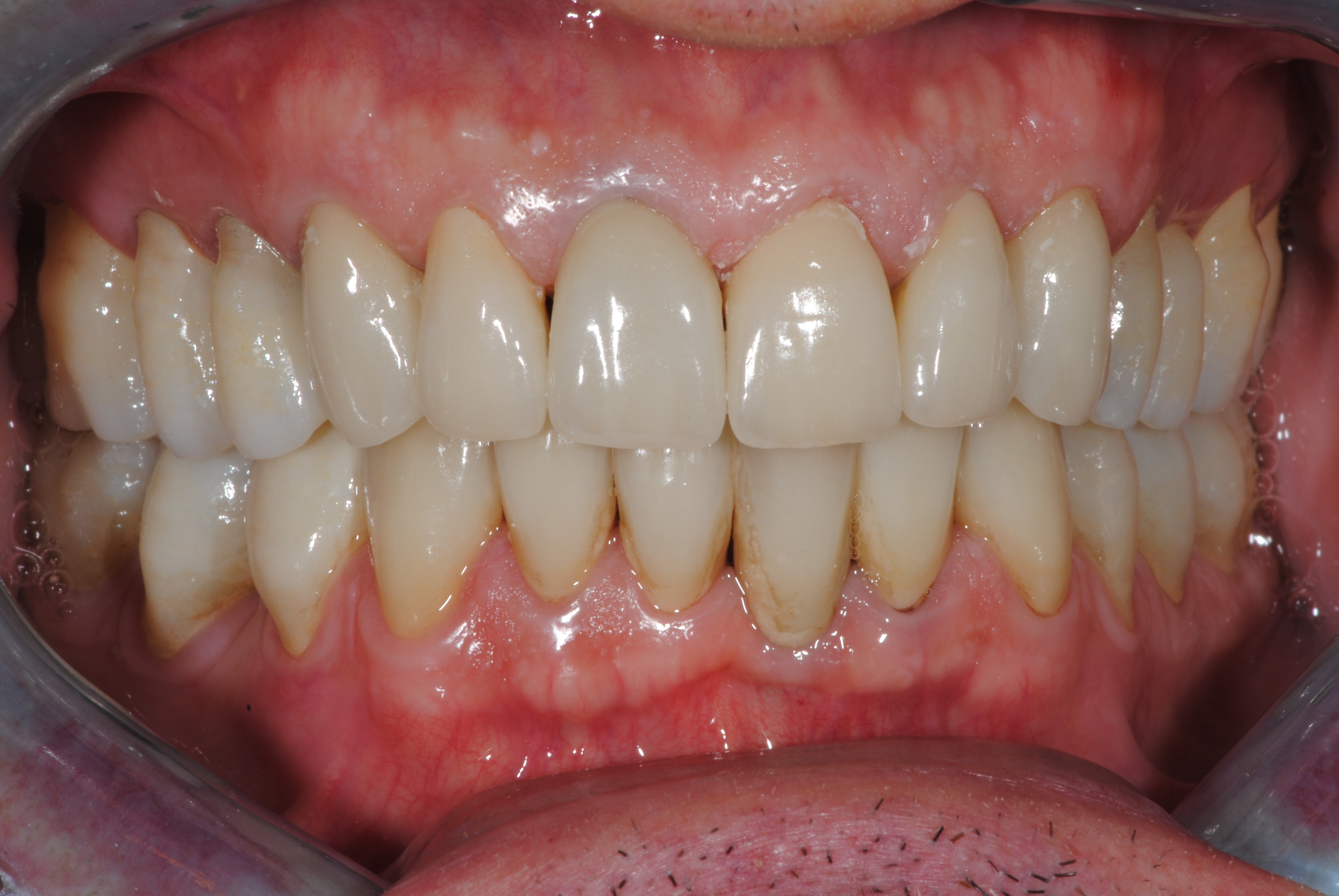 Elementi singoli in ZIRCONIA-CERAMICA