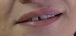 Ortodonzia Invisibile - Diastema