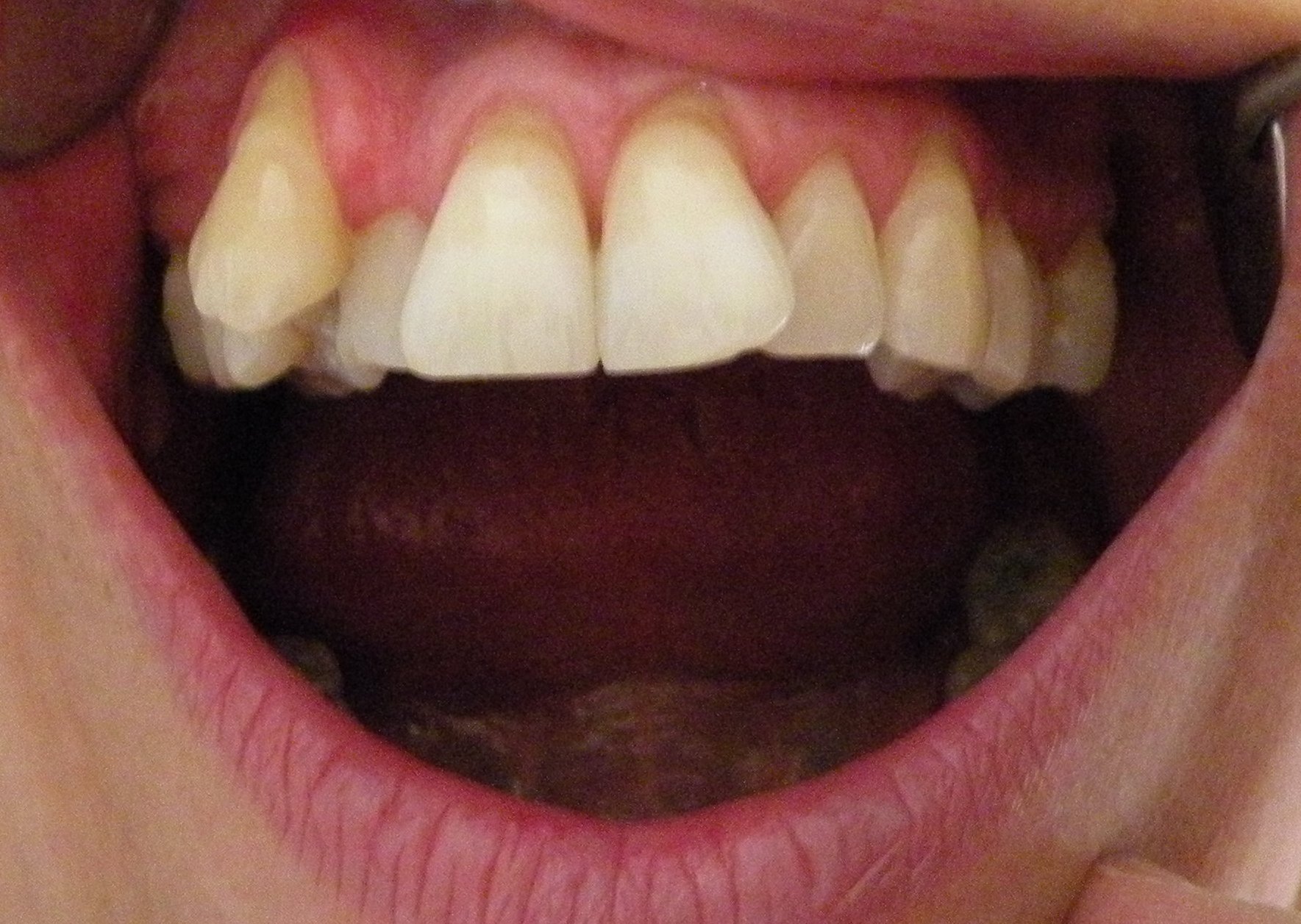 Affollamento dentario - Invisalign