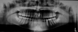 Sostituzione del dente singolo in zona estetica