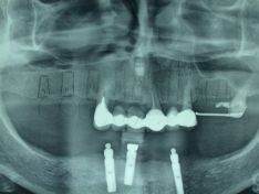 Riabilitazione totale con ponti su impianti