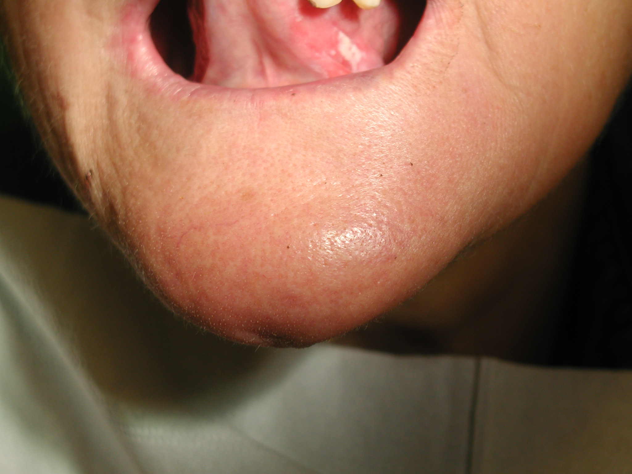 Lesione bianca della lingua da protesi incongrua