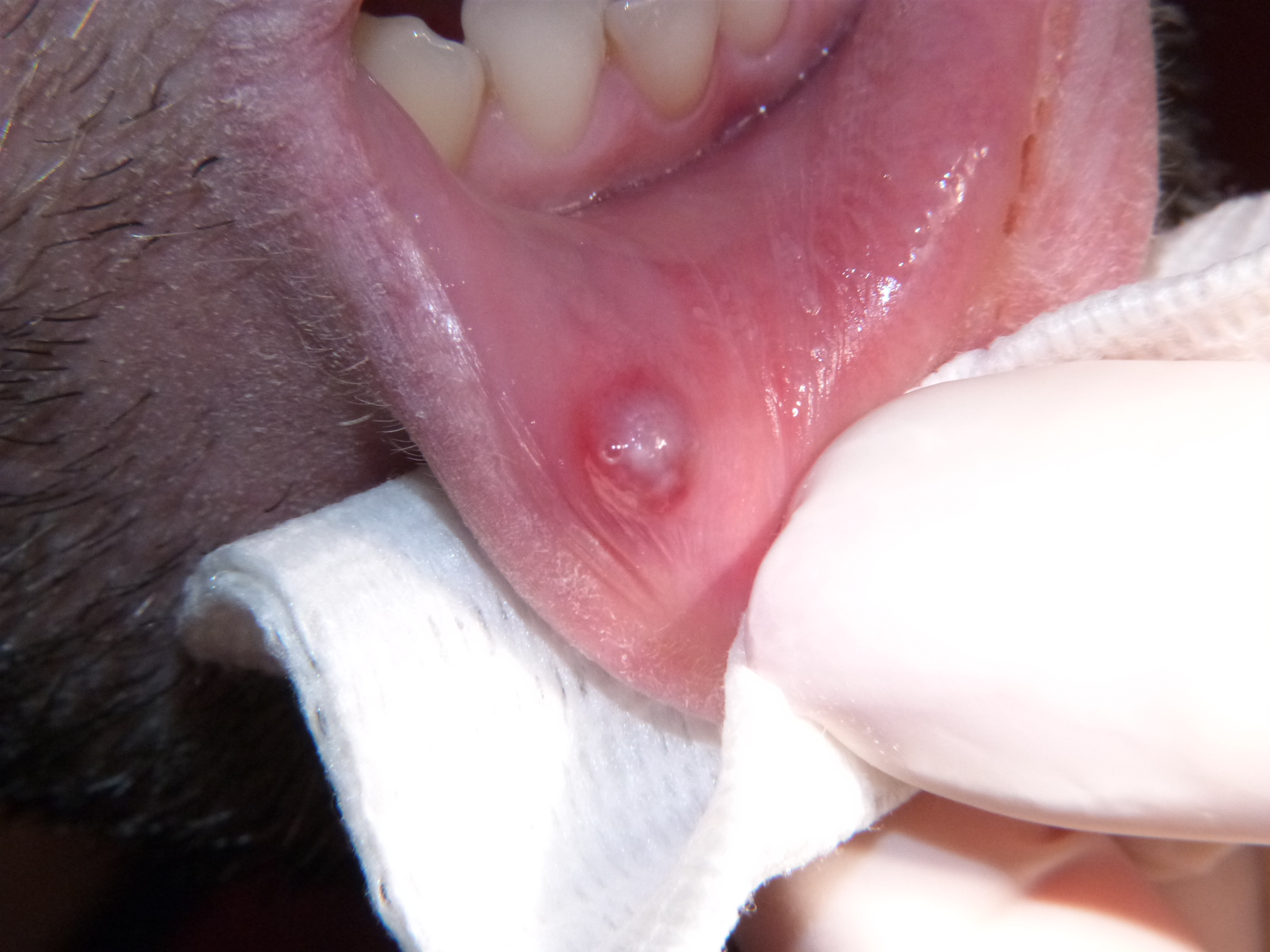 Rimozione di mucocele labiale