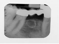 Rimozione di Tumore Odontogeno Cheratocistico mandibolare