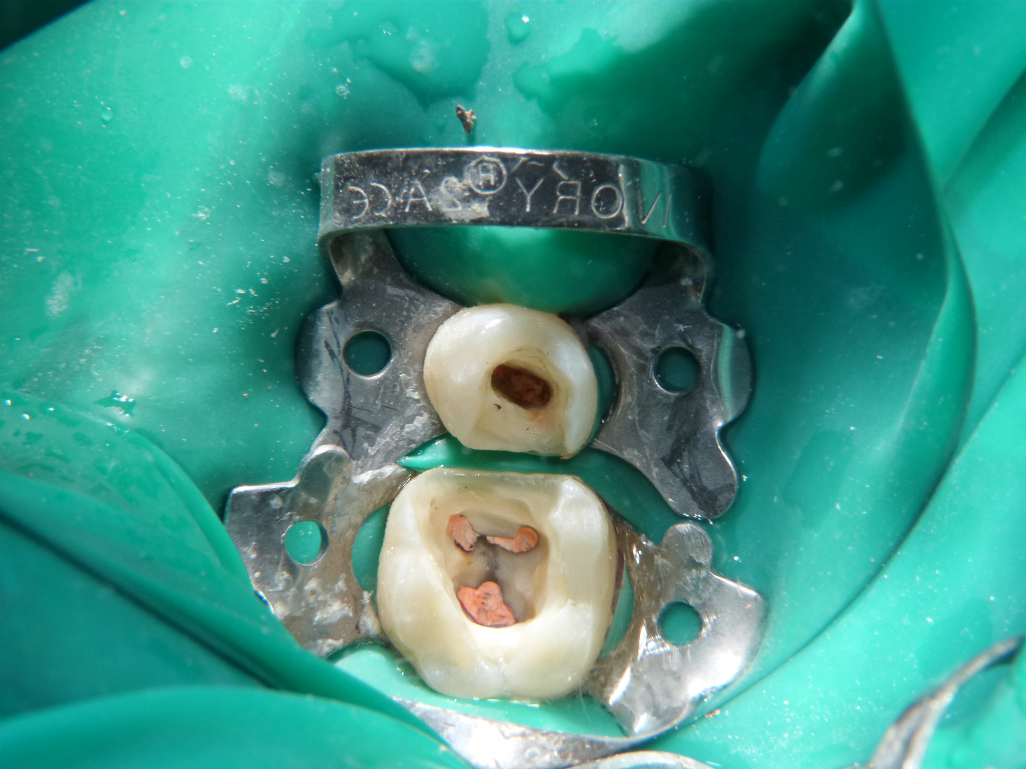 Restauro indiretto mediante endo-crown di elementi trattati endodonticamente