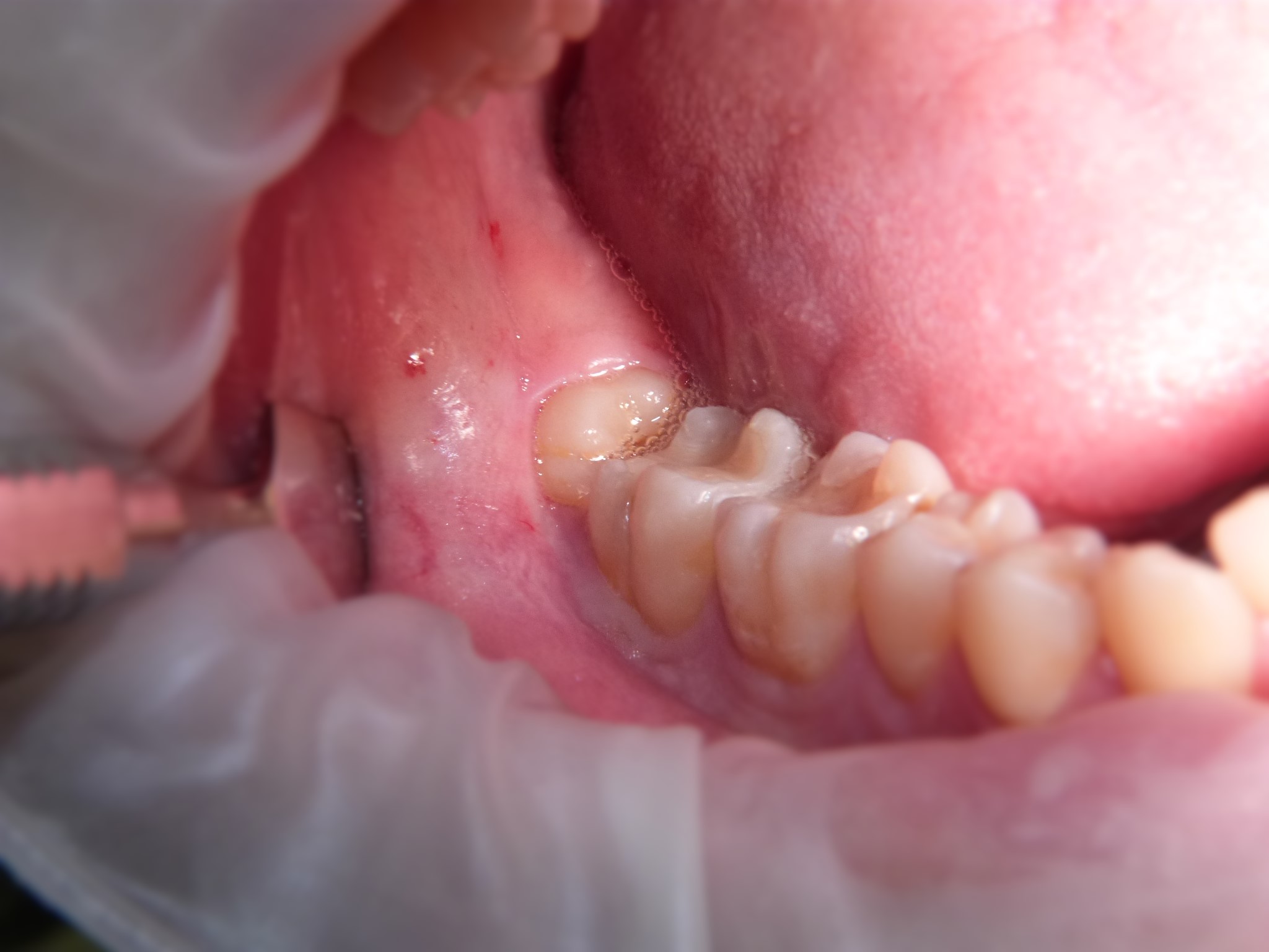 Estrazione chirurgica di ottavo inferiore in disodontiasi
