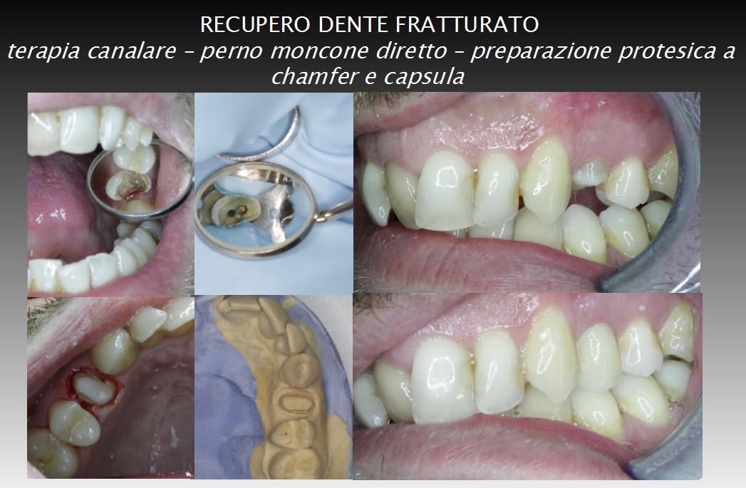 recupero di elemento fratturato con ottimo risultato estetico