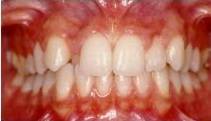 Affollamento dentario anteriore