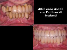 Riabilitazione Completa su impianti