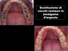 Sostituzione di vecchi restauri in amalgama d'argento