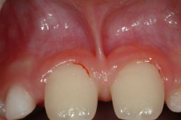 Frenulectomia labiale superiore con laser
