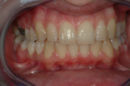 Sbiancamento con laser a diodi
