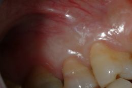 Chirurgia endodontica