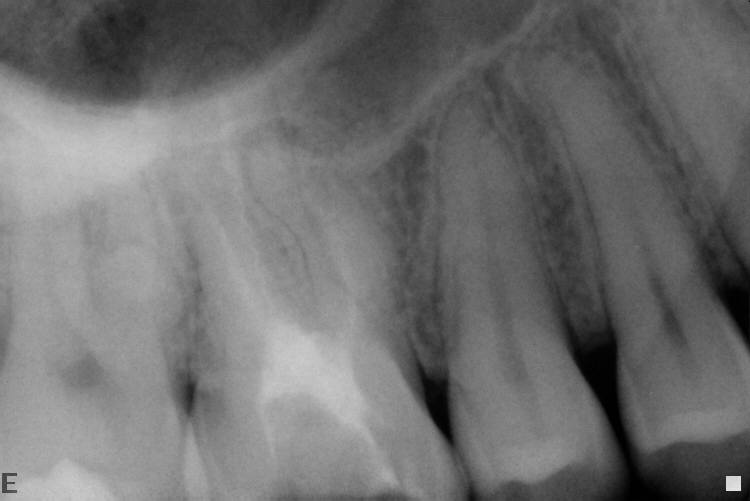 Ritrattamento endodontico dopo rimozione di strumentino spingi-pasta.
