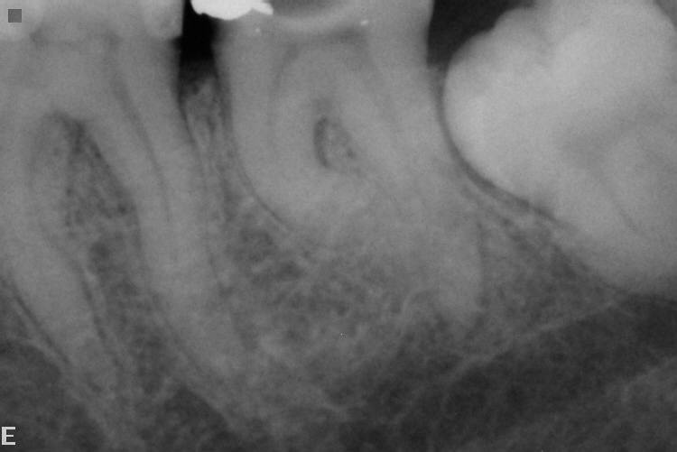 Trattamenti endodontici