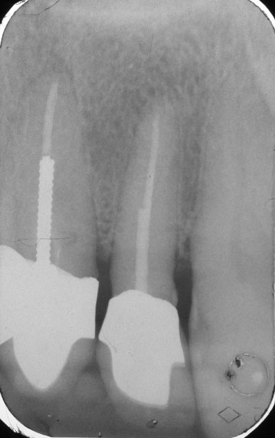 Rimozione di perno endodontico