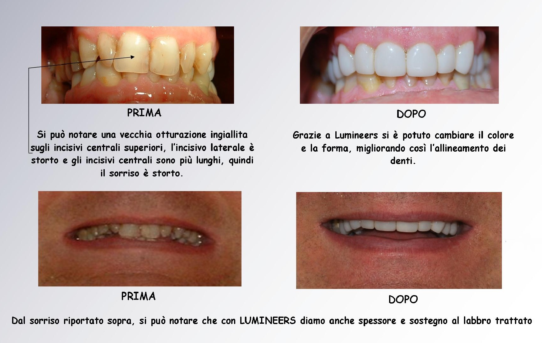 Faccette dentali: Lumineers