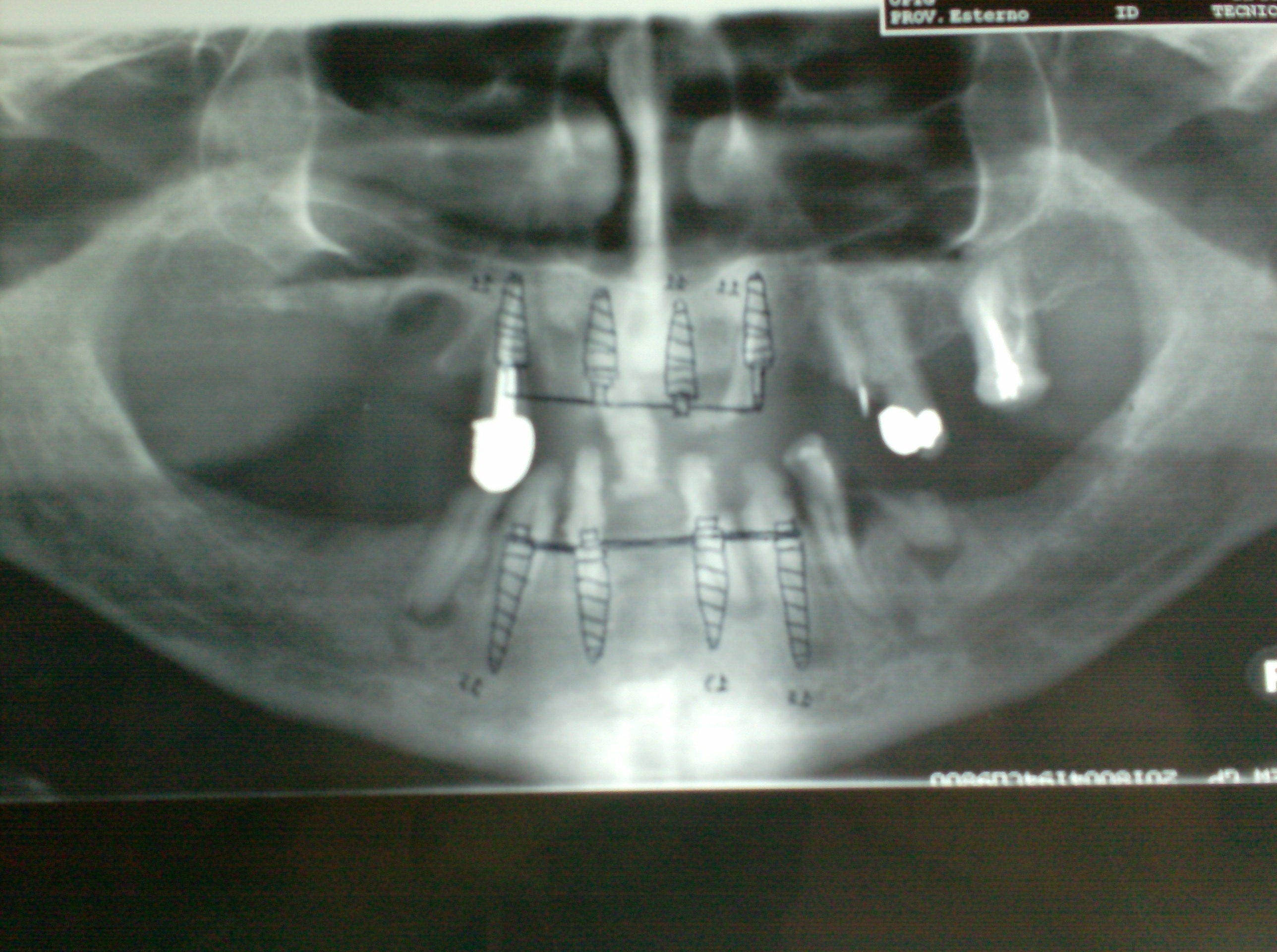 Overdenture superiore ed inferiore con impianti postestrattivi elettrosaldati a carico immediato