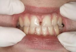 Diastema tra i due incisivi centrali superiori