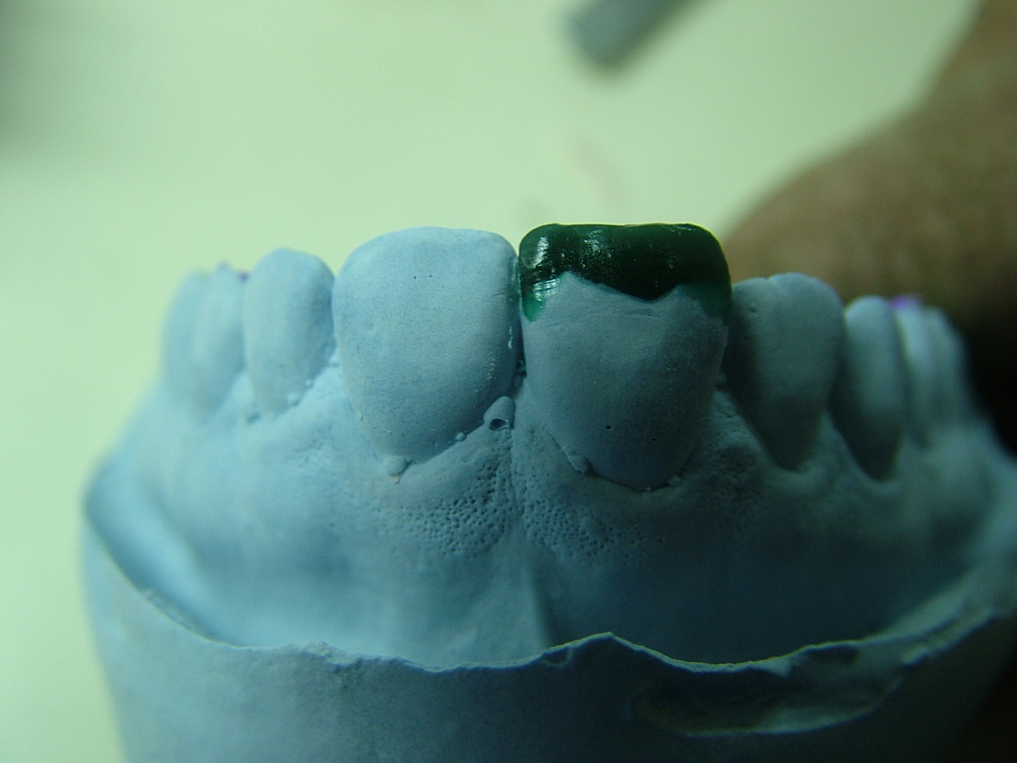 Ricostruzione adesiva nei traumi dentali