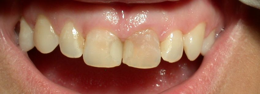 Corone metal free in composito