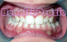 Ortodonzia linguale in paziente di sesso femminile di 12 anni. Dr Orazio Bennici