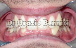 Blocco mandibolare. Dr Orazio Bennici