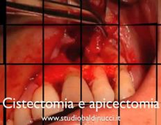 Apicectomia Cistectomia Dott. Baldinucci Napoli