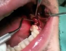 Rimozione cisti con elemento dentale