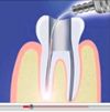 Endodonzia Laser