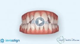 Invisalign - OpenDay