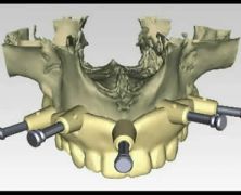 Implanto-protesi computer assistita