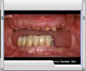 Video Implantologia Dr. Deodato - 01