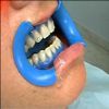 Sbiancamento Dentale