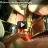 Estrazione terzo molare verticale difficile con mectron piezosurgery