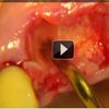 Piezosurgery immediate 4.3 mm conical implants with kaps operative microscope